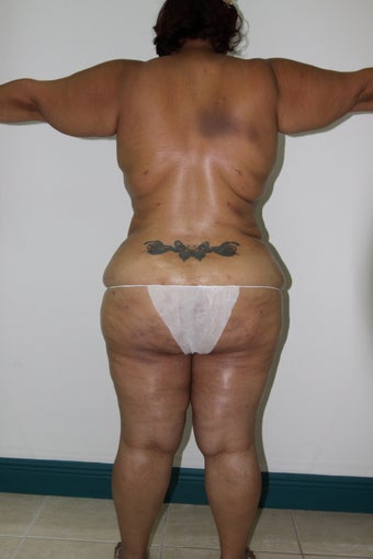 Brazilian Butt Lift after 514684