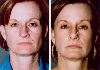 Non-Surgical Face Lift- Exoderm before 242964