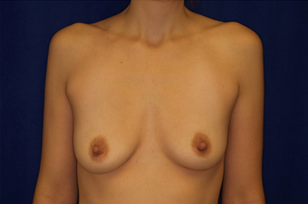 Breast Augmentation before 336009