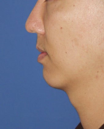 Chin Implant 414146