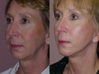 Chin Implant before 381159