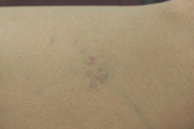 Spider vein removal with laser treatments before 106554