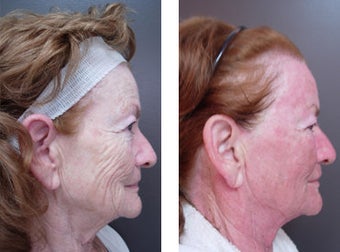 CO2 Fractional Laser before 561102