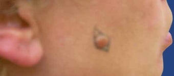 Mole Removal before 513303