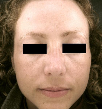 Pro-Fractional plus Chemical Peel after 333391