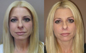 Juvederm Before and After before 625358