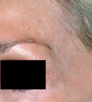 Laser facial vein treatment after 374363