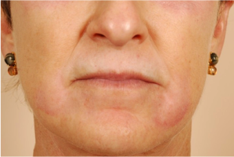 Deep Peel - Phenol-Croton Oil after 1159456