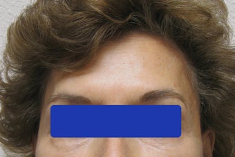 60 year old female treated with Botox for forehead lines before 821664