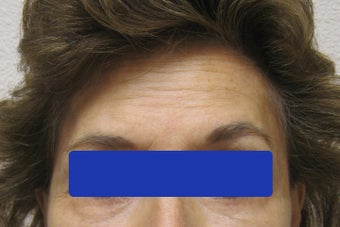 60 year old female treated with Botox for forehead lines after 821664
