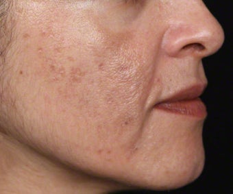 Cosmelan for Melasma and Pigmented Acne Scars after 539875