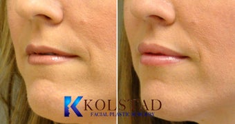 Lip Augmentation 671907