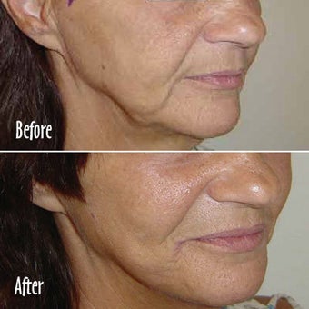 Threadlift of jowls and chin before 6818