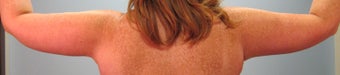 40-year-old female Brachioplasty/Arm Lift after 699046