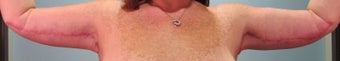 40-year-old female Brachioplasty/Arm Lift 699046