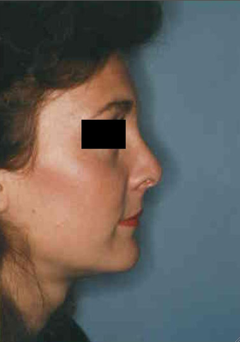 Revision Rhinoplasty after 665097