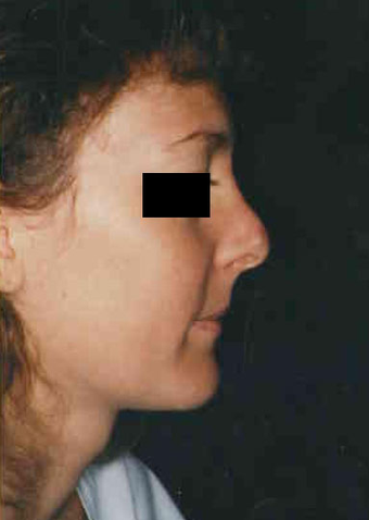 Revision Rhinoplasty before 665097