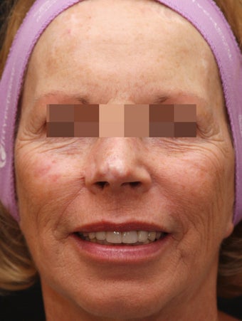 Fraxel Repair for Sun Damage and Wrinkles before 113204