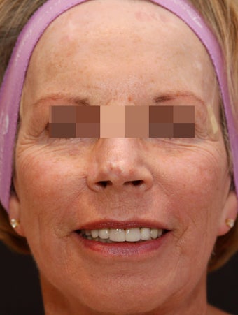 Fraxel Repair for Sun Damage and Wrinkles after 113204