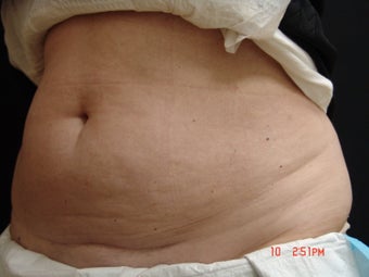 Coolsculpting before 495010
