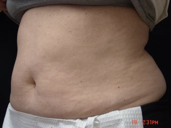 Coolsculpting after 495010