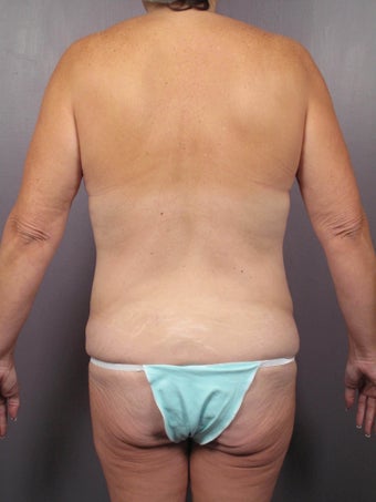 Bodylift before 653559