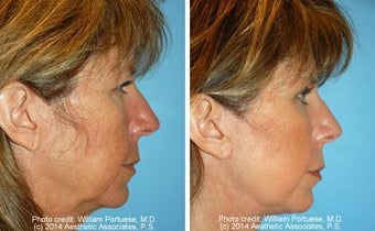 Facelift before 91468