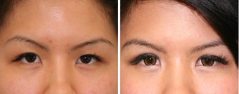 Double Eyelid Before & After Photos Patient 11 before 1230261