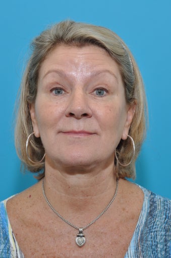 60-year-old female for 1st Botox Treatment before 924507