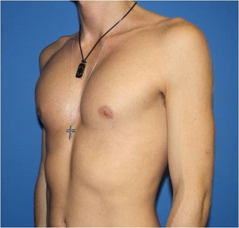 Pectoral Augmentation, Pec Implants after 665732