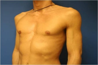 Pectoral Augmentation, Pec Implants before 665732