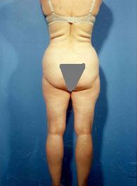 Liposuction of Back Rolls before 289515