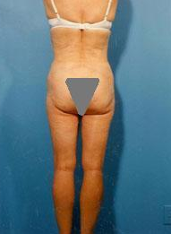 Liposuction of Back Rolls after 289515