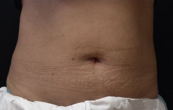 Coolsculpting Abdomen after 625387