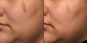 PicoSure before 1006790