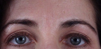 Botox to forehead "11" lines after 240863