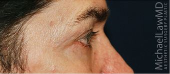 Eye Bag Surgery 887211