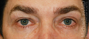 Eye Bag Surgery after 887211