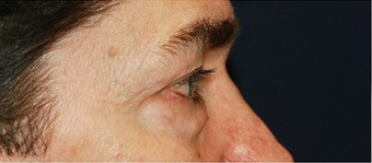 Eye Bag Surgery 887211