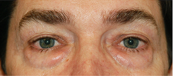 Eye Bag Surgery before 887211