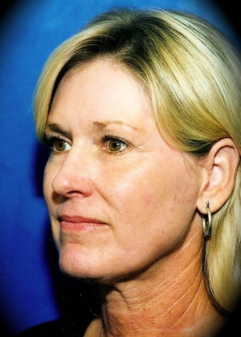 Laser Skin Resurfacing after 837044