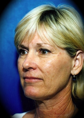 Laser Skin Resurfacing before 837044