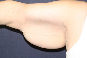 Brachioplasty (Arm Lift) 508321