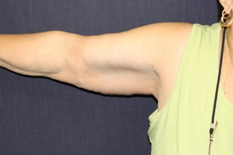 Brachioplasty (Arm Lift) 508321