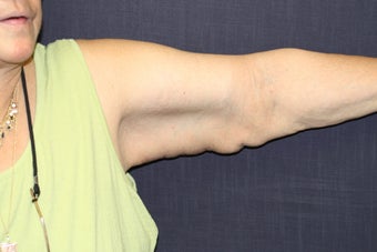 Brachioplasty (Arm Lift) after 508321