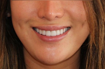 Lip Implant and Dimple Creation after 598462