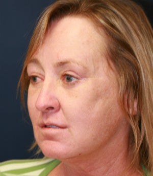 Lip Lift and Corner Lift 845412