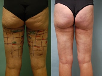 Cellulaze anti-cellulite treatment of buttocks and thighs before 648115