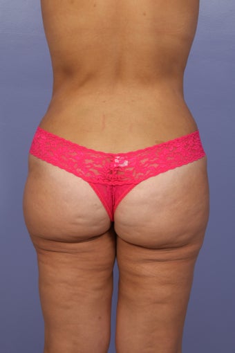 Overall body lift. after 658400