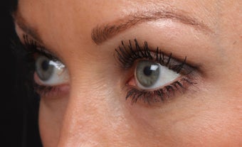 Filler for Under-Eye Hollows after 1350727